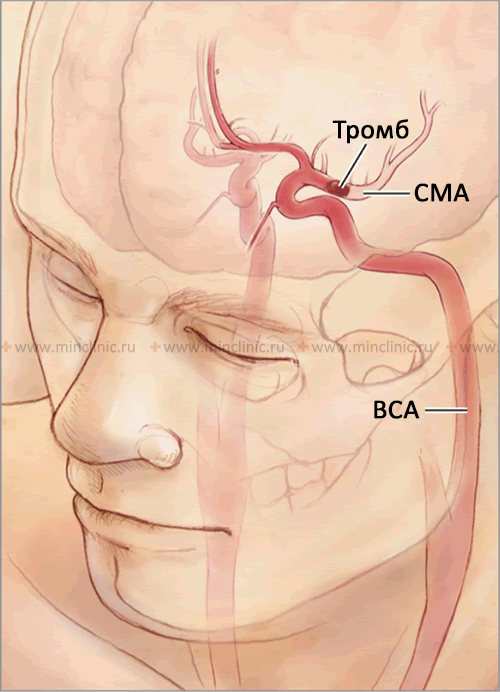 Эмболии сосудов головного мозга (церебральные эмболии) Иллюстрация эмболии левой средней мозговой артерии (СМА), которая является ветвью внутренней сонной артерии (ВСА).